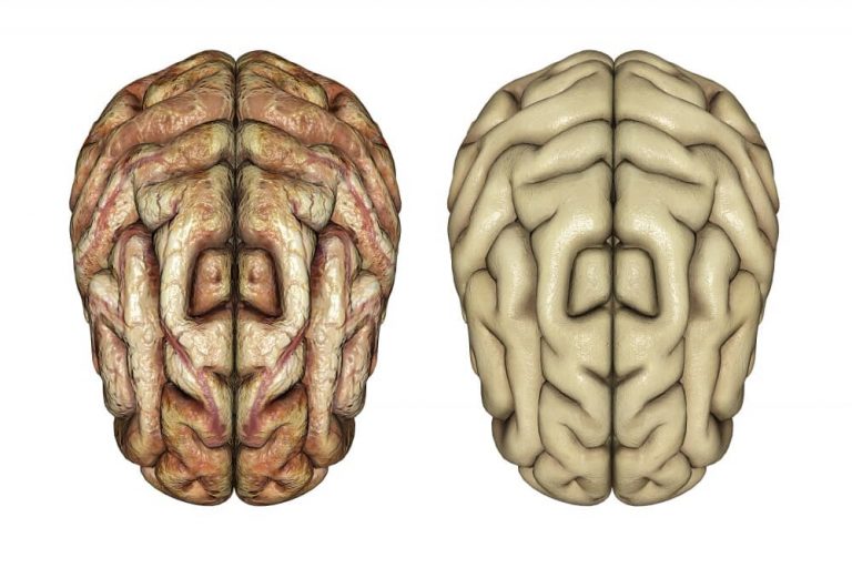 ¿Qué son las enfermedades neurodegenerativas?